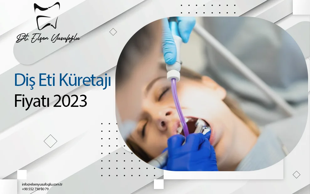 Diş Eti Küretajı Fiyatı 2023